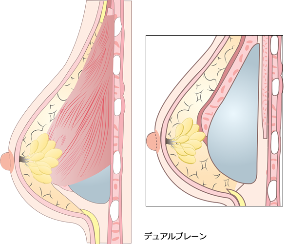 魅力的なバスト・豊胸術