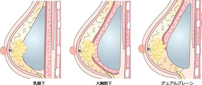 魅力的なバスト・豊胸術