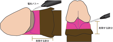 電気メス 削除する部分