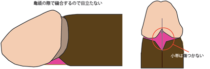 亀頭近辺で目立たくなるように縫合して完成です。小帯も保存され、縫線もずれません。