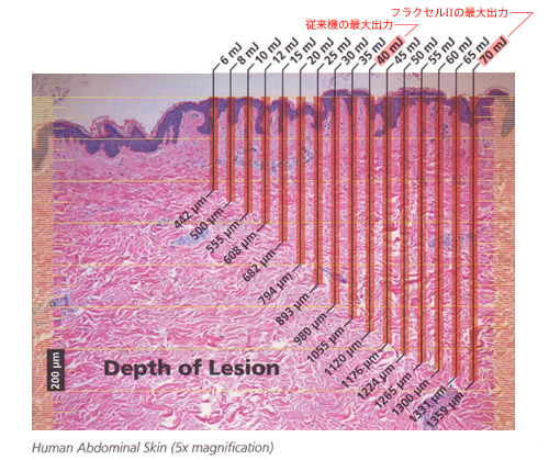 フラクセルレーザーのエネルギー量と深達度の相関図