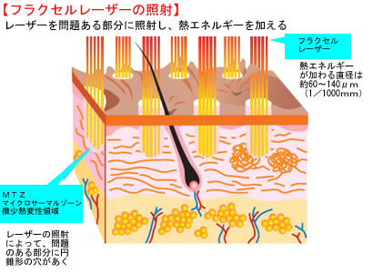 フラクセルレーザーの照射