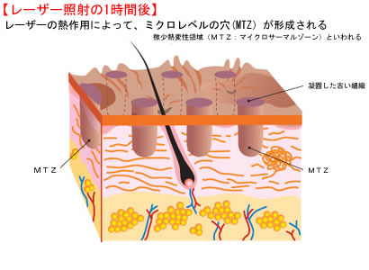 レーザー照射の1時間後