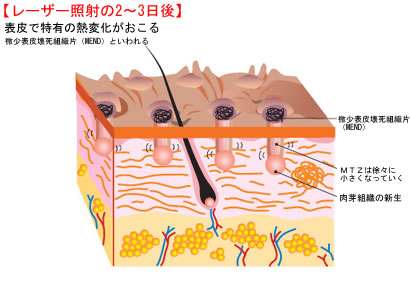レーザー照射の2~3日後
