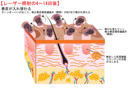 レーザー照射の4~14日後