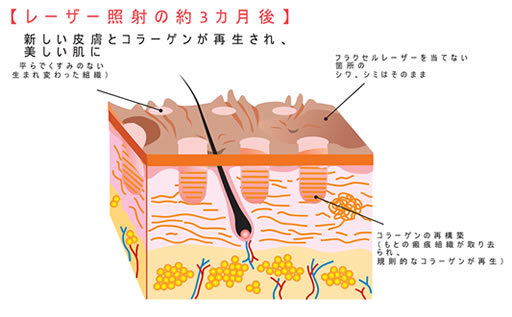 レーザー照射の約3ヶ月後