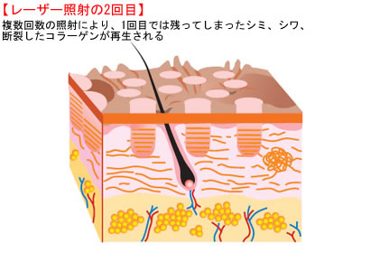 レーザー照射の2回目