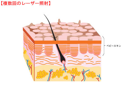 複数回のレーザー照射