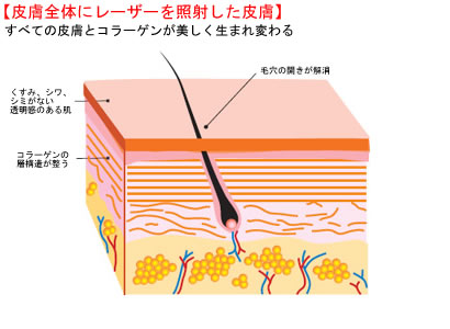 皮膚全体にレーザーを照射した皮膚