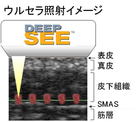 ウルセラ照射イメージ