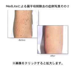 MedLite（メドライト）による扁平母斑除去の症例写真その2 Before After