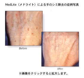 MedLite（メドライト）による顔のシミ除去の症例写真 Before After