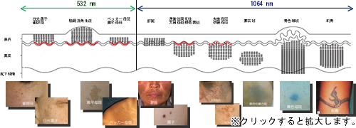 当院所有のQ-YAG・Pico-YAGレーザーの適用