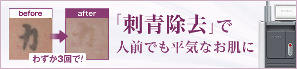 「刺青除去」で人前でも平気なお肌に