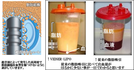 超音波によって発生した高周波で脂肪組織を血管を傷つけることなく剥がしていきます。　従来の脂肪吸引に比べて出血量がはるかに少ないことが一目でわかると思います