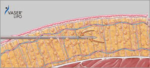 脂肪を専用カニューレで吸引