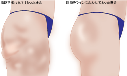 脂肪を採れるだけとった場合 脂肪をラインに合わせてとった場合