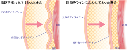 脂肪を採れるだけとった場合 脂肪をラインに合わせてとった場合