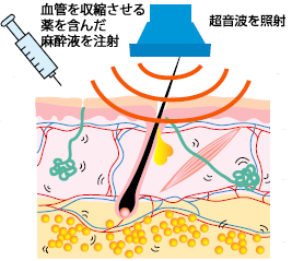 麻酔を打ったあと、3～5ミの切開を施す