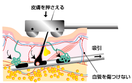 ローラーで皮膚を圧迫し、皮下の削除機に密着させることでアポクリン汗腺やエクリン汗腺などを効率的に吸収できる。