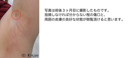 写真は術後３ヶ月目に撮影したものです。指摘しなければ分からない程の傷口と、周囲の皮膚の良好な状態が御覧頂けると思います。