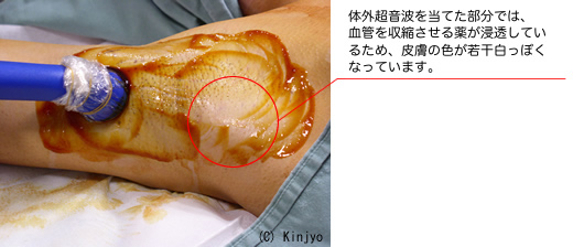 体外超音波を当てた部分では、血管を収縮させる薬が浸透しているため、皮膚の色が若干白っぽくなっています。