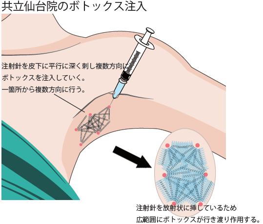 共立仙台のボトックス注入法