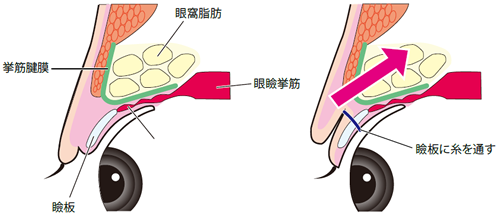 他院　瞼板法