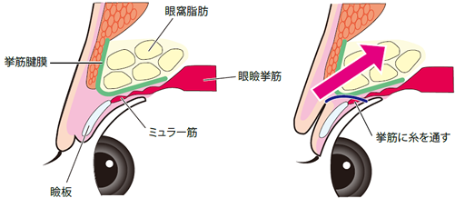 共立式　挙筋法