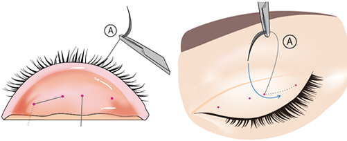 1.瞼の内側から瞼板に糸を通し、外側にでた糸を再度皮膚へ通します。