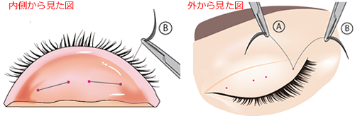 2.通した糸の反対側（B）も瞼板から糸を通し、最初の糸と結びます