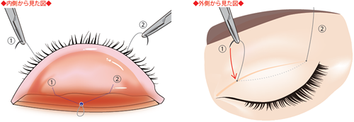 1.瞼の内側から瞼板より奥にある挙筋に細いナイロンの糸を通します。