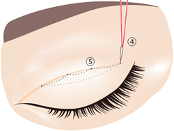 4.両端からの糸を結びます。そして、端の糸に別の糸を通して（④）、引き上げることで⑤の結び目を皮膚の中へ入れることができます。
									  