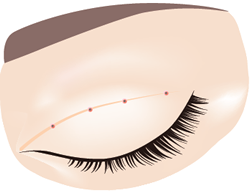 5.結び目がしっかり中に入り、図のように４点の跡が残ります。目を開いた時に意図が皮膚を引いて平行型の二重のラインが綺麗にでます。