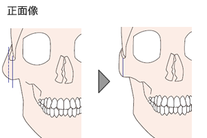 頬骨が横に突出している場合 正面像