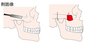 頬骨が横に突出している場合 側面像