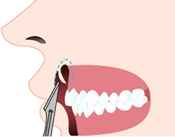 上唇の内側と歯茎の皮膚をメスで切り取ります。