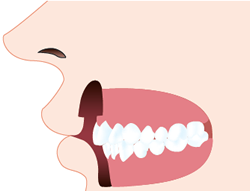 皮膚を切り取ることで組織が癒着します。