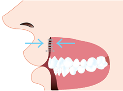 唇と歯茎を縫合します。