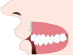 糸による縫合と皮膚の癒着でしっかりとくっつきます。