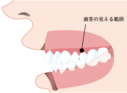 唇の開きが抑えられ、歯茎はほとんど露出しません。