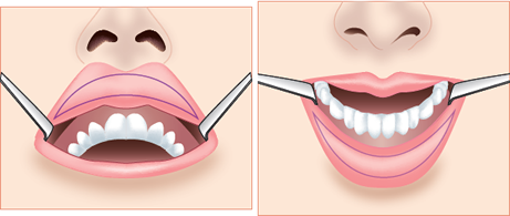 上唇の施術 下唇の施術