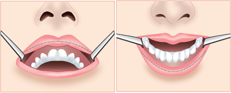 上唇の施術 下唇の施術