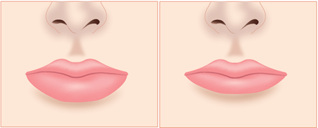 上唇の施術 下唇の施術