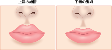 上唇の施術 下唇の施術