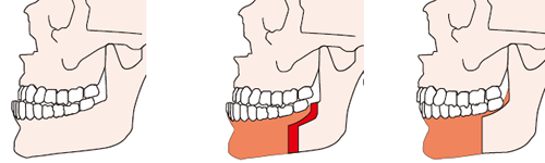 下歯槽骨骨切り