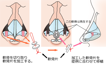 軟骨を切り取り軟骨片を加工する。 加工した軟骨片を症例に合わせて移植