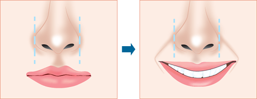 7.剥離して小鼻を引き寄せているため、小鼻が広がりません