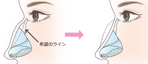 ワシ鼻を沢山削り、凹ませたカーブにする