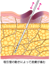 他院吸引例 吸引管の動きによって皮膚が痛む